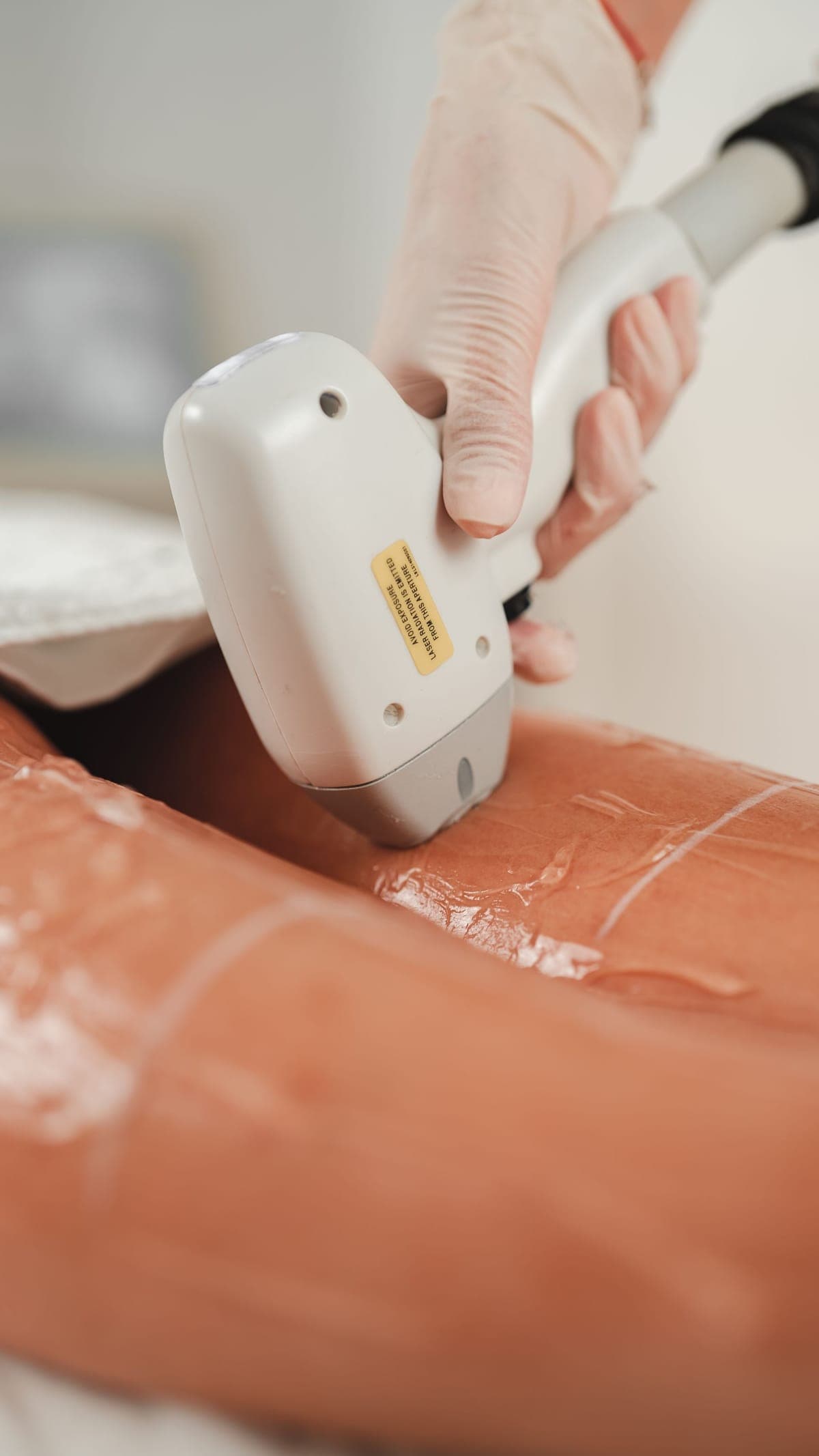 Laser lipolysis handpiece applied to a treatment area at Longevity Newport