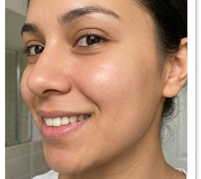 Acne & Scarring — after