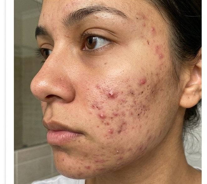 Acne & Scarring — before
